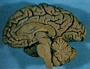 Right Half of The Brain: Midsagittal Section