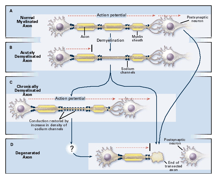 Axons - DeMyelination